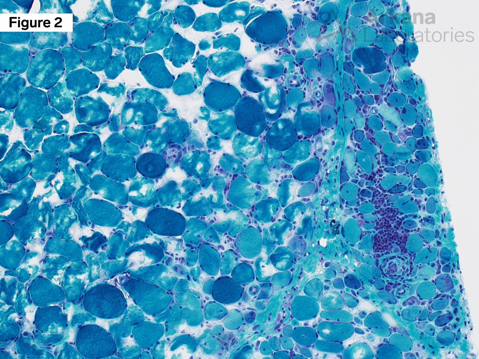 MxA Figure 2: Modified Gomori Trichrome frozen section 200x original