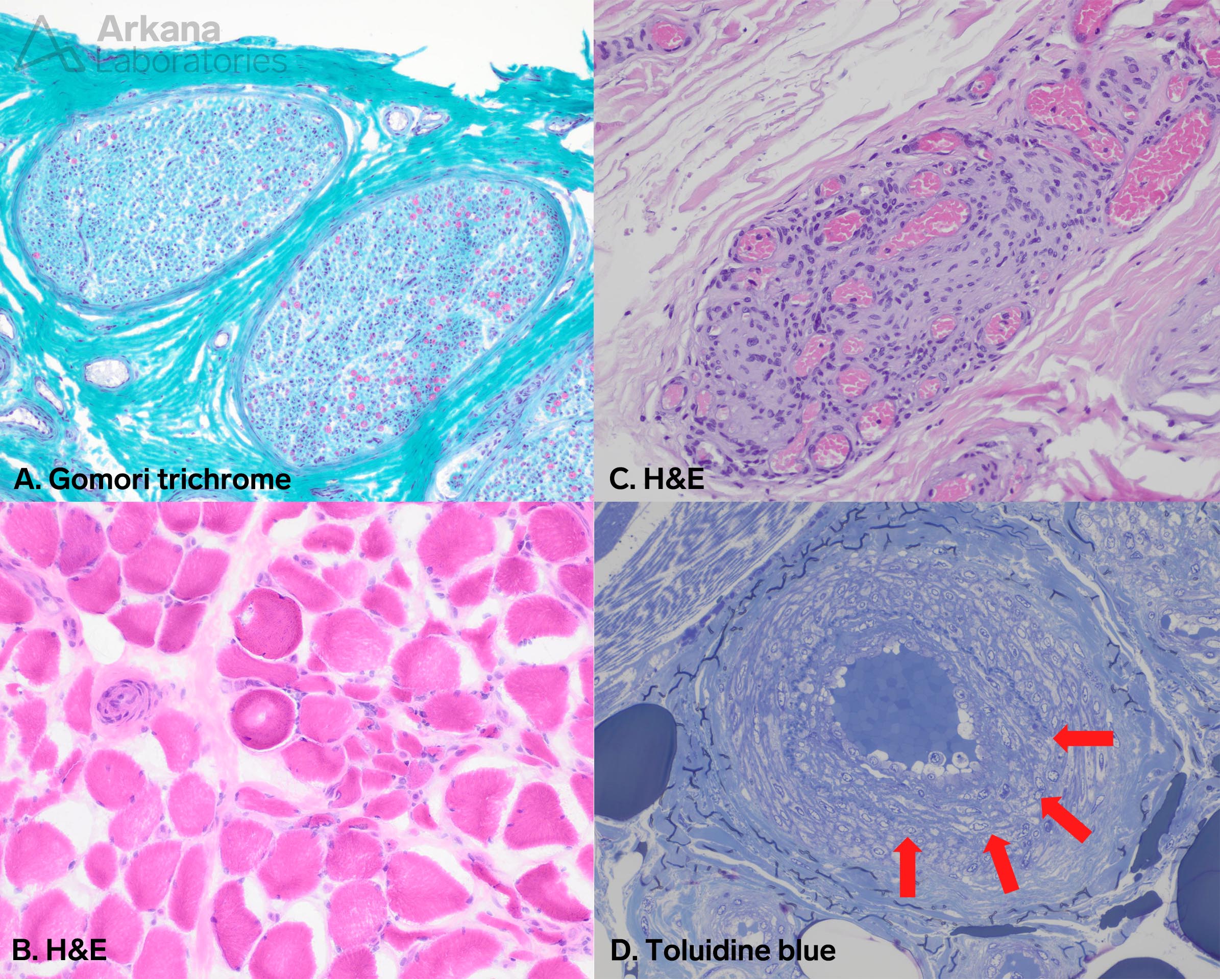 Vasculitis