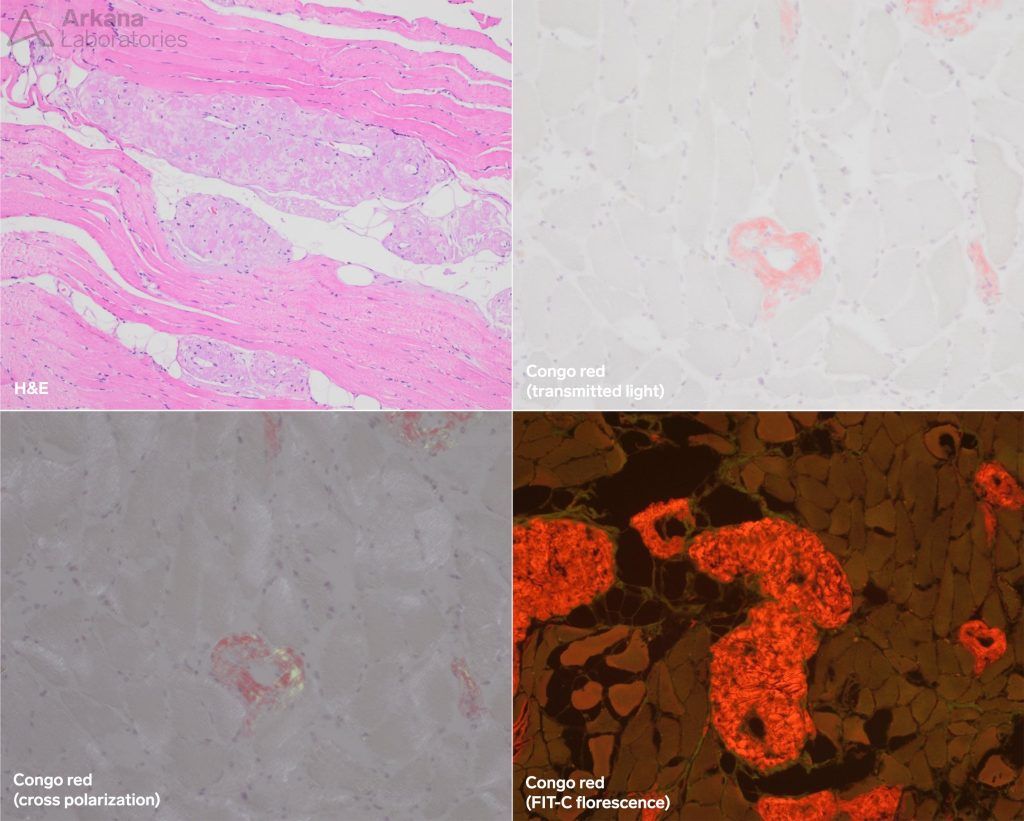 Myopathy in Acute Lymphoma