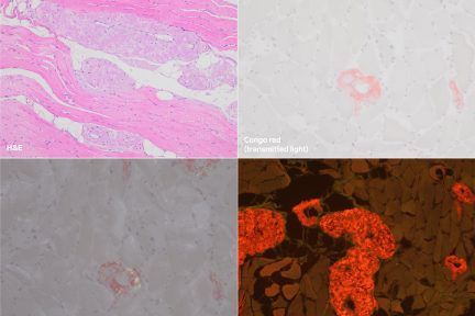 Myopathy in Acute Lymphoma