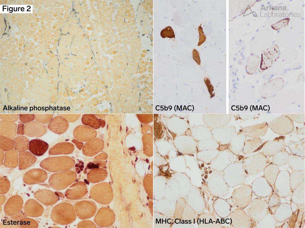 Necrotizing Myopathy