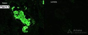 light chain cast nephropathy