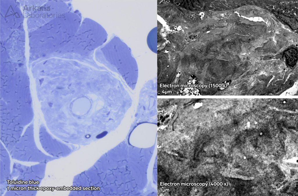 Myopathy in Acute Lymphoma