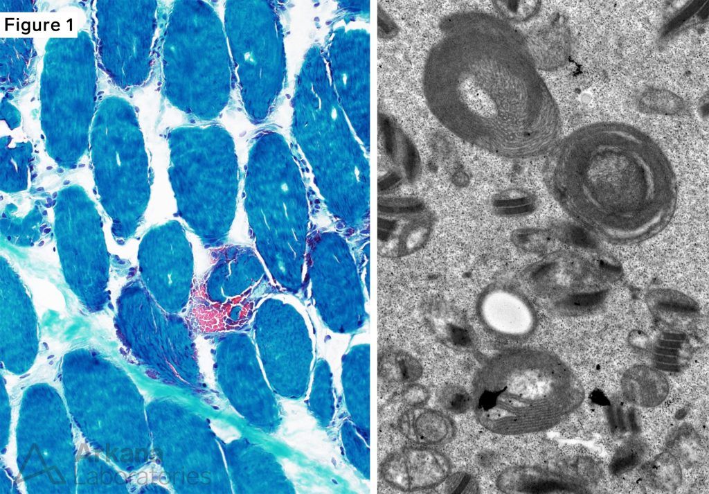 Mitochondrial Myopathy