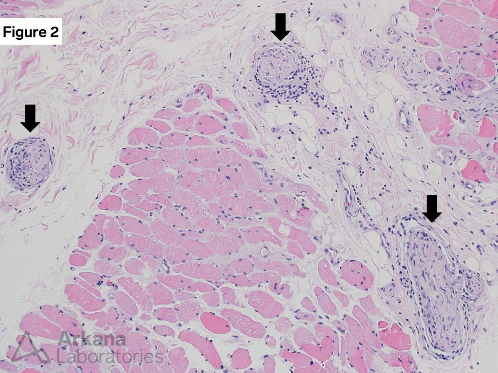 "neuromyositis."