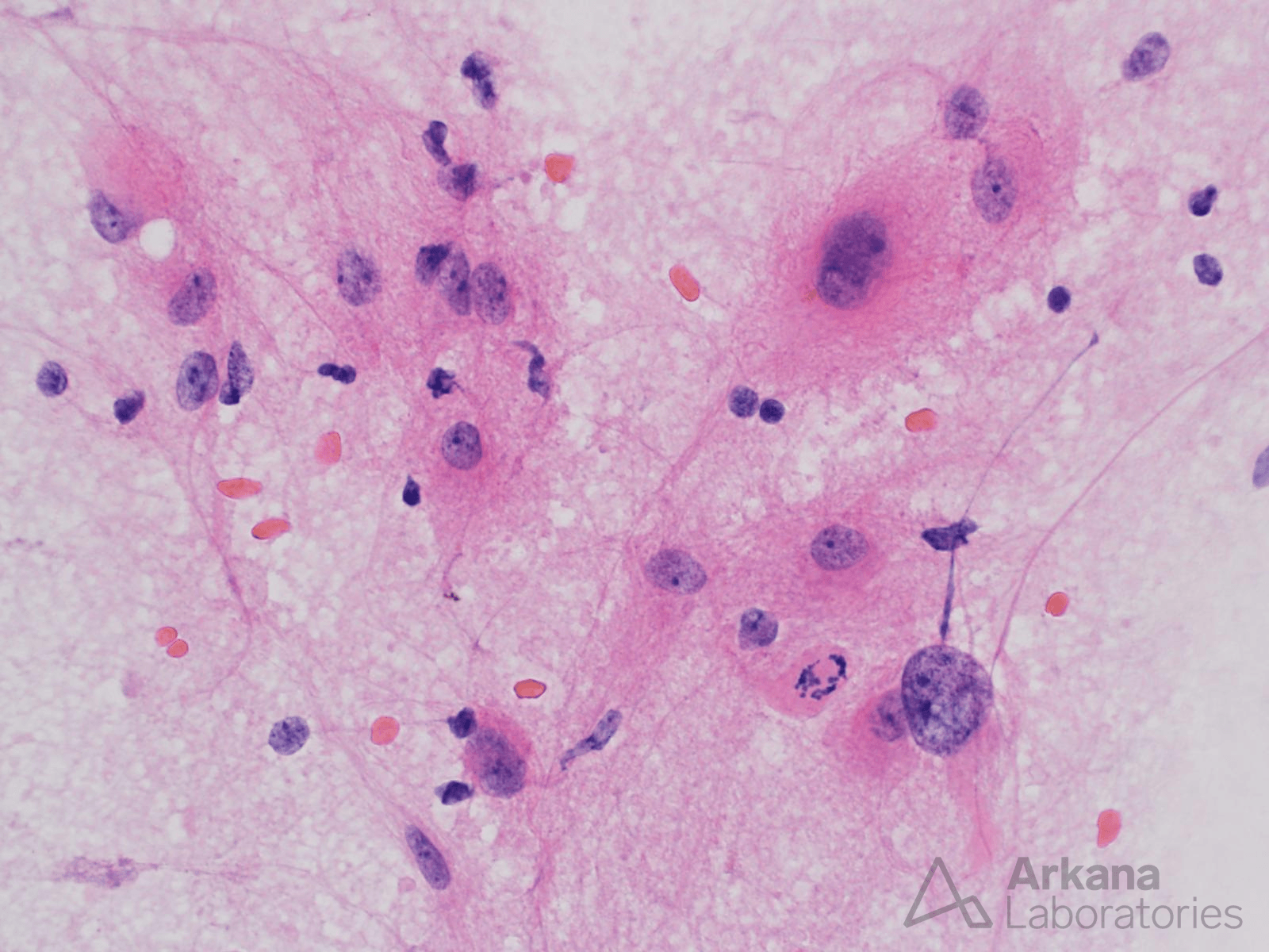 astrocytic neoplasm