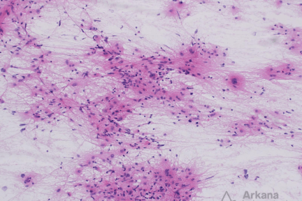 astrocytic neoplasm