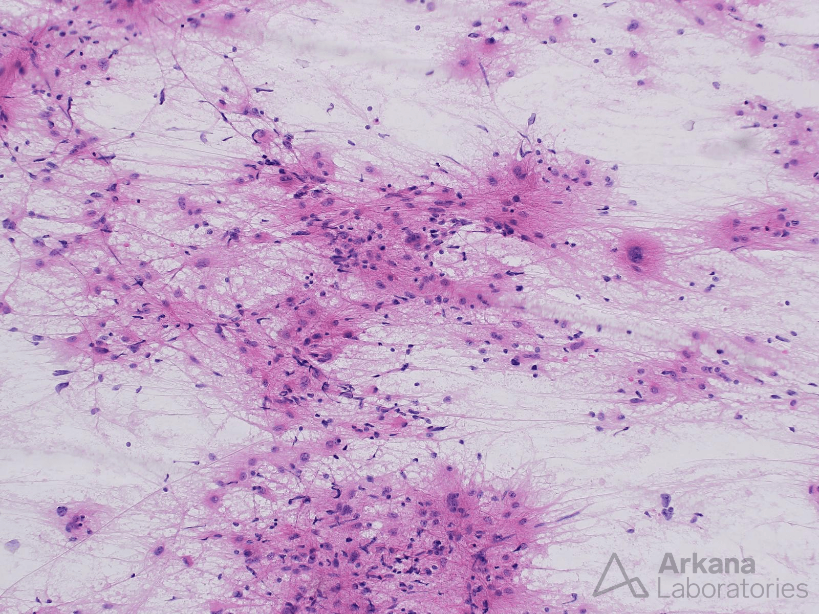 astrocytic neoplasm