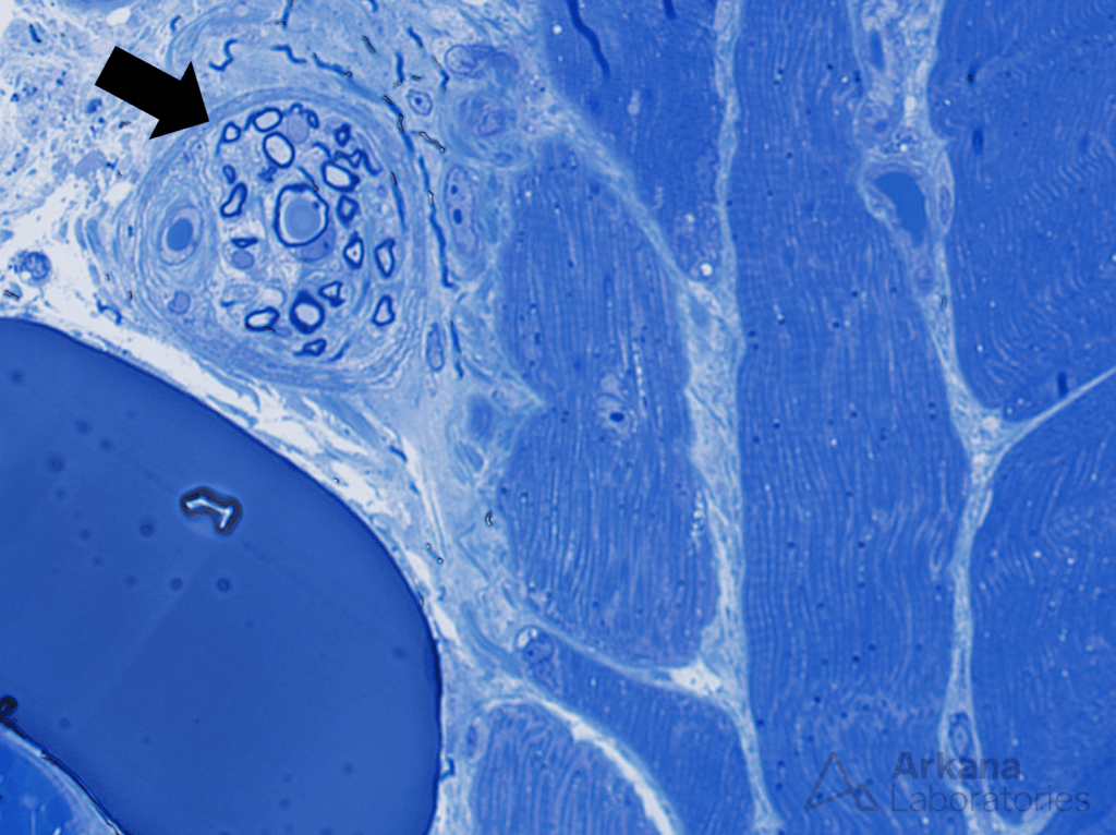 Figure 1: Toluidine blue stained thick section 600x original magnification. Nerve fascicle