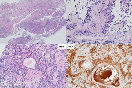 Ependymoma