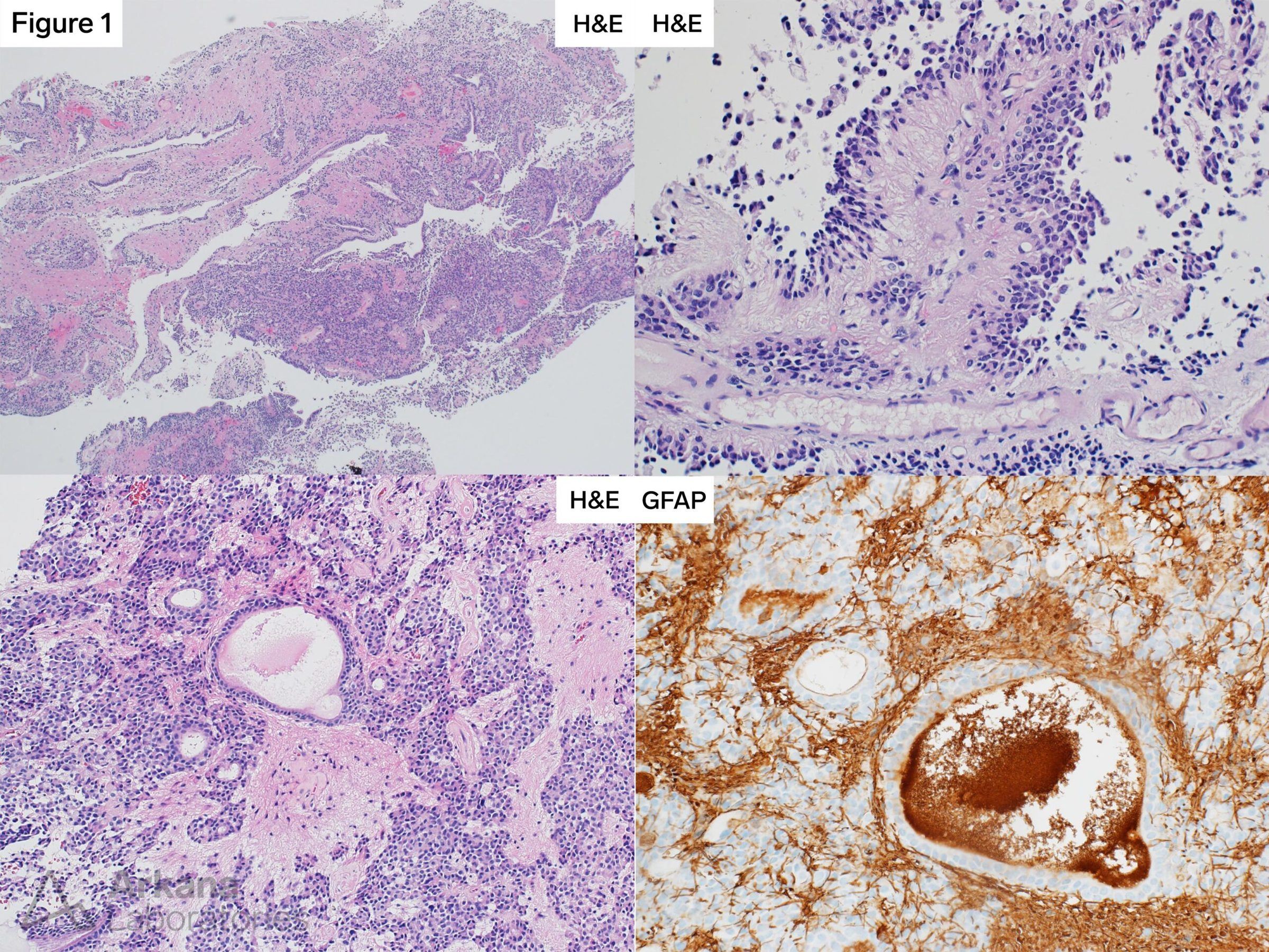 Ependymoma