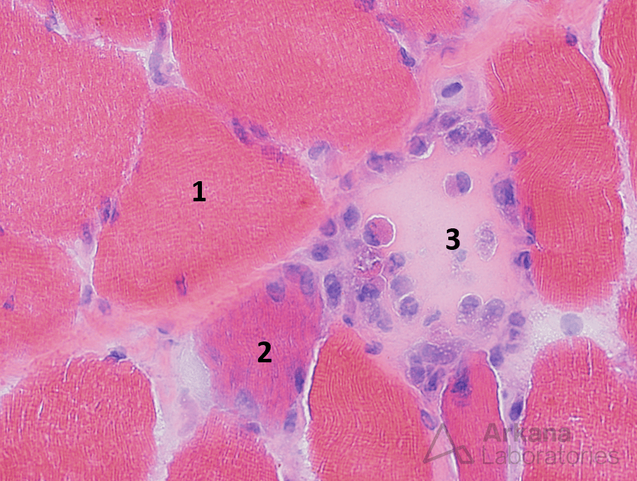 Myofiber injury