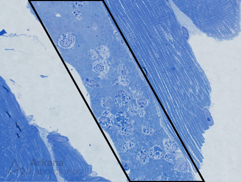 Myofiber injury