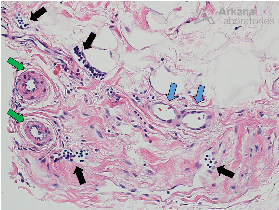 Lymphatic spaces