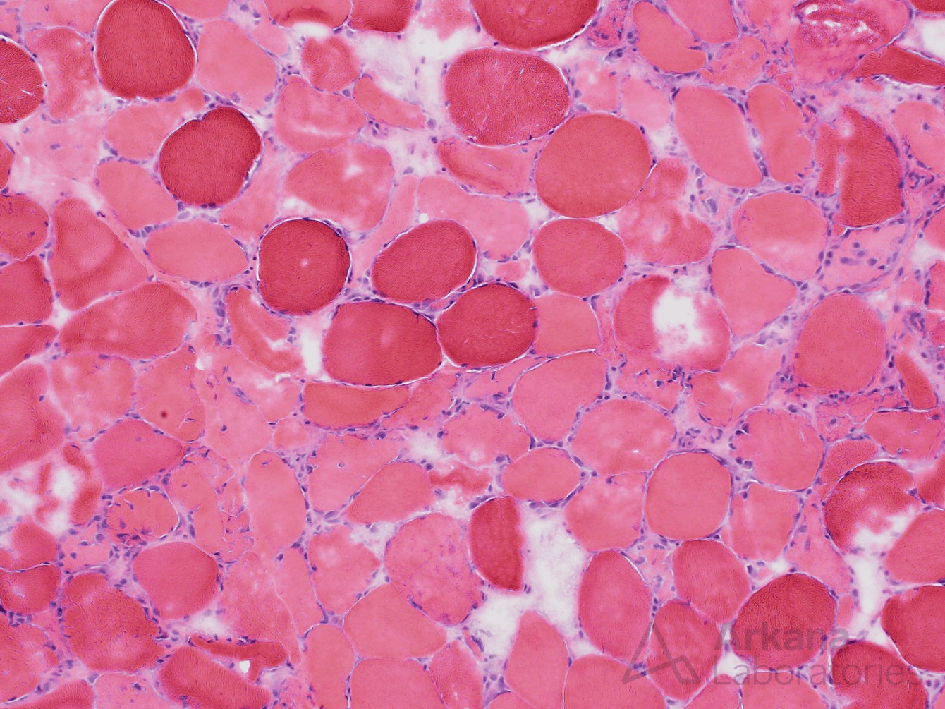 Necrotic myofibers, Rhabdomyolysis