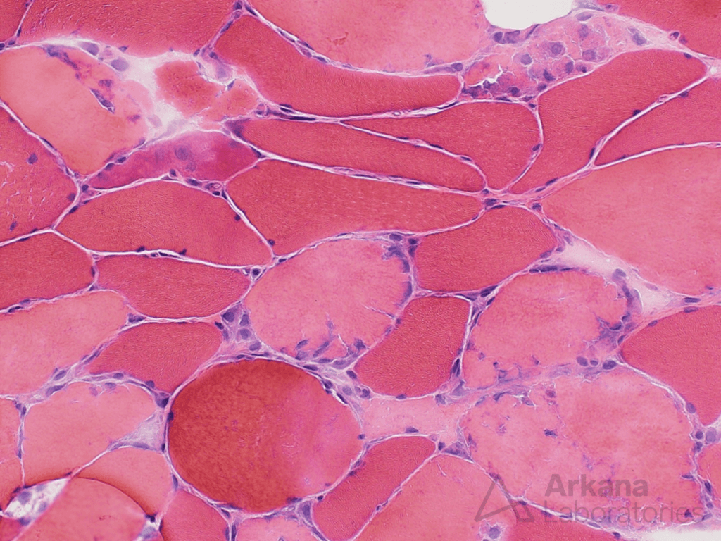 Necrotic myofibers, Rhabdomyolysis