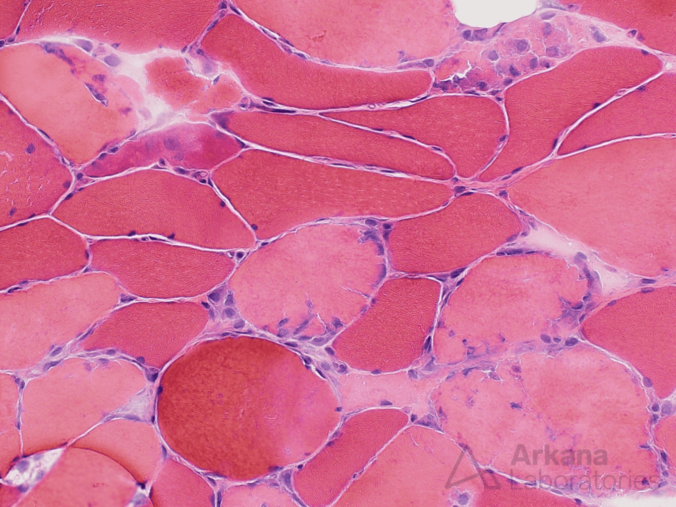 Necrotic myofibers, Rhabdomyolysis