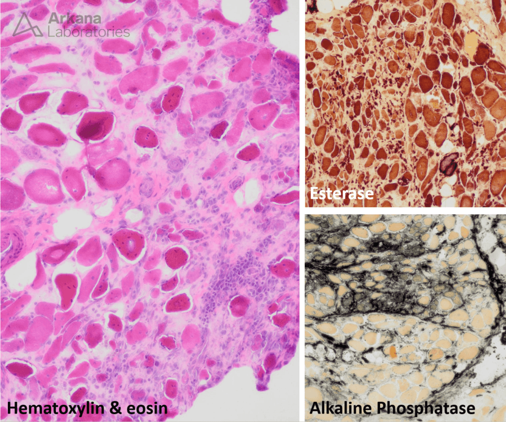 Dermatomyositis with treatment effect