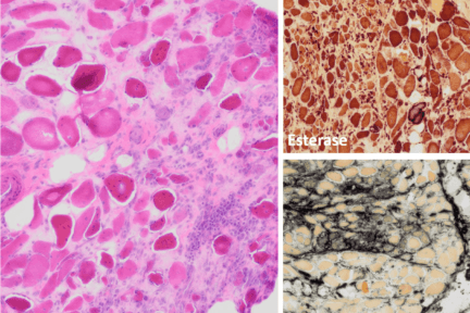 Dermatomyositis with treatment effect