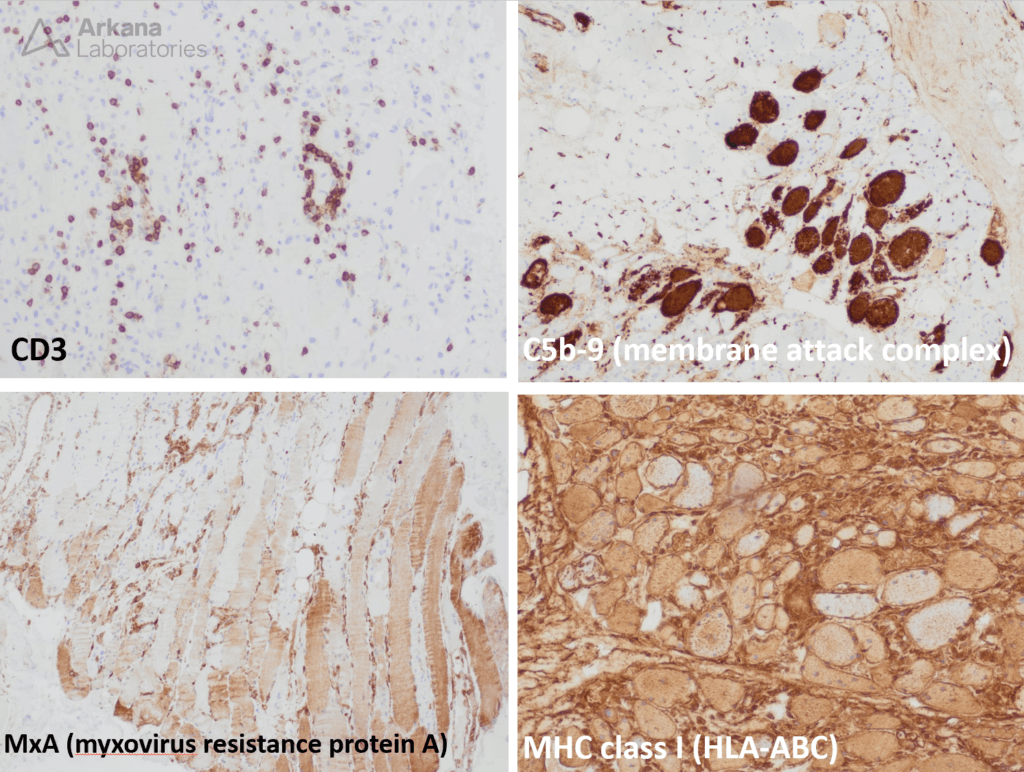 Dermatomyositis with treatment effect