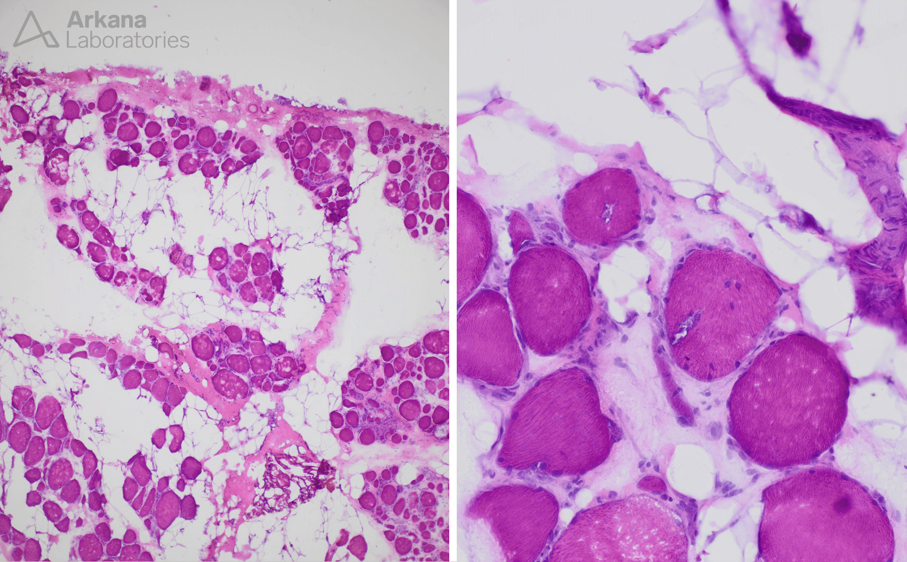 Inclusion body myopathy , IBM,