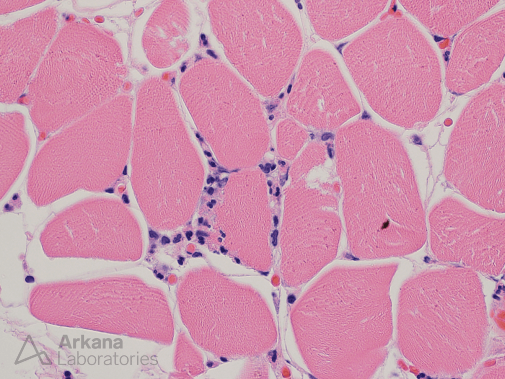 Ischemic myopathy