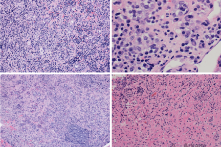 Lymphocytic hypophysitis