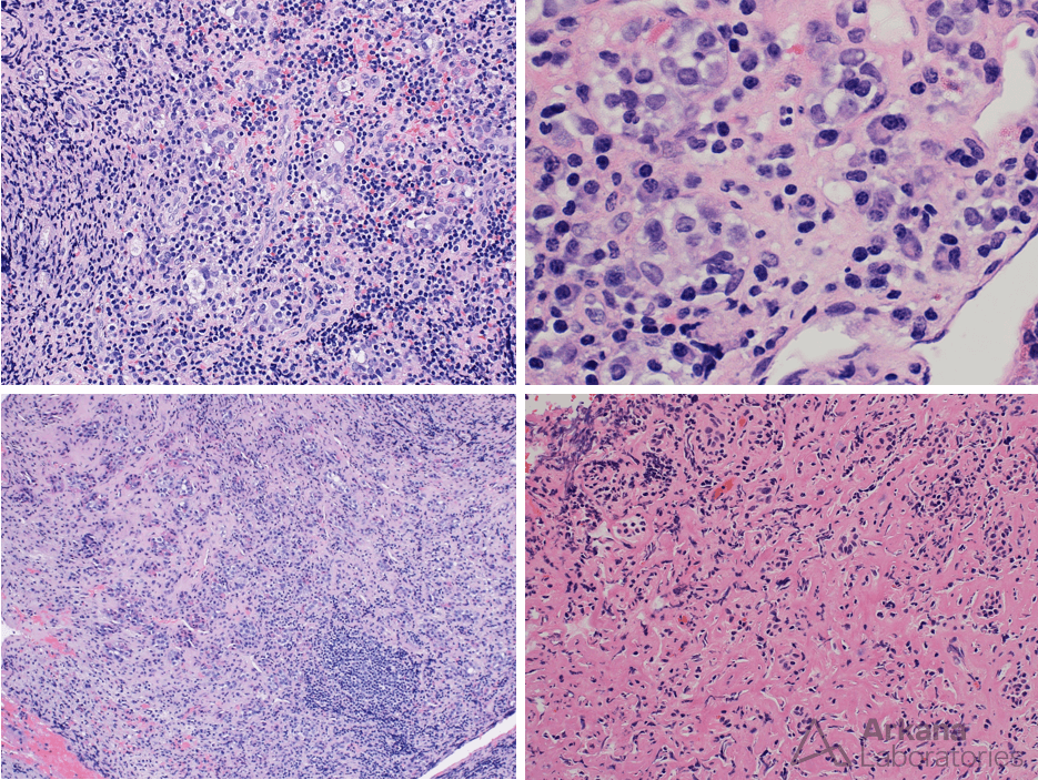 Lymphocytic hypophysitis