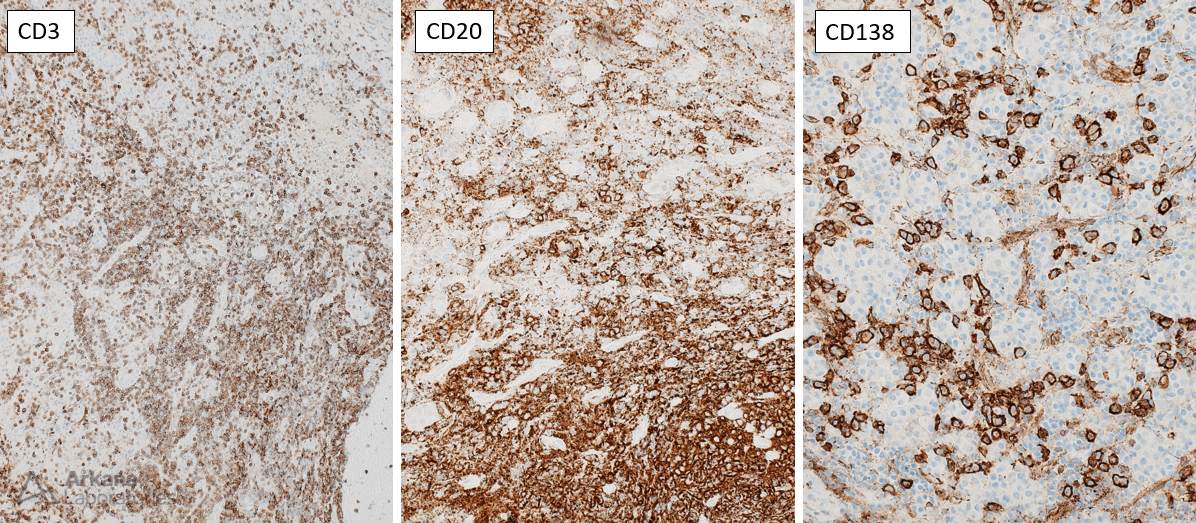 Lymphocytic hypophysitis