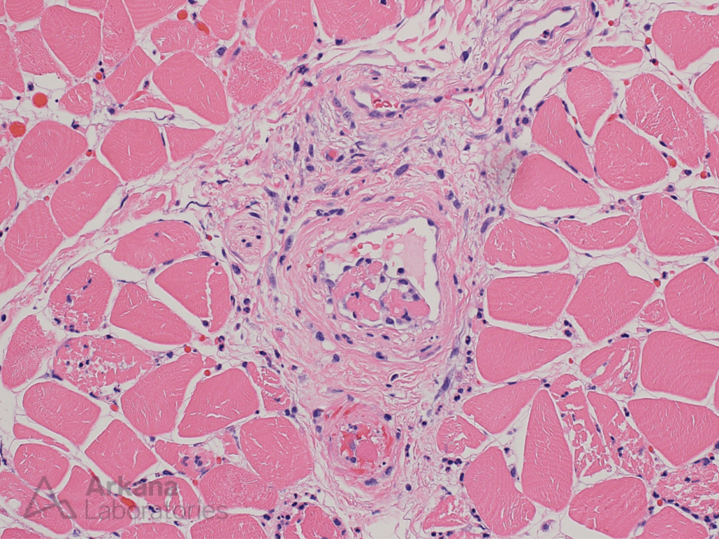 Ischemic myopathy