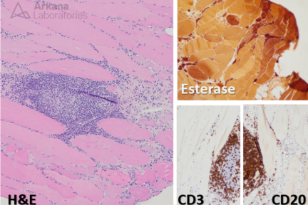 Focal myositis