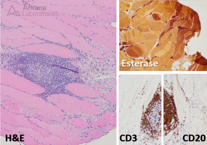 Focal myositis, Unilateral Calf Enlargement