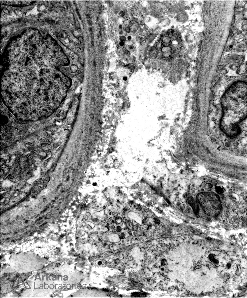 monoclonal immunoglobulin deposition disease, MIDD