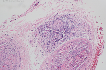 Unusual Inflammatory Neuropathy