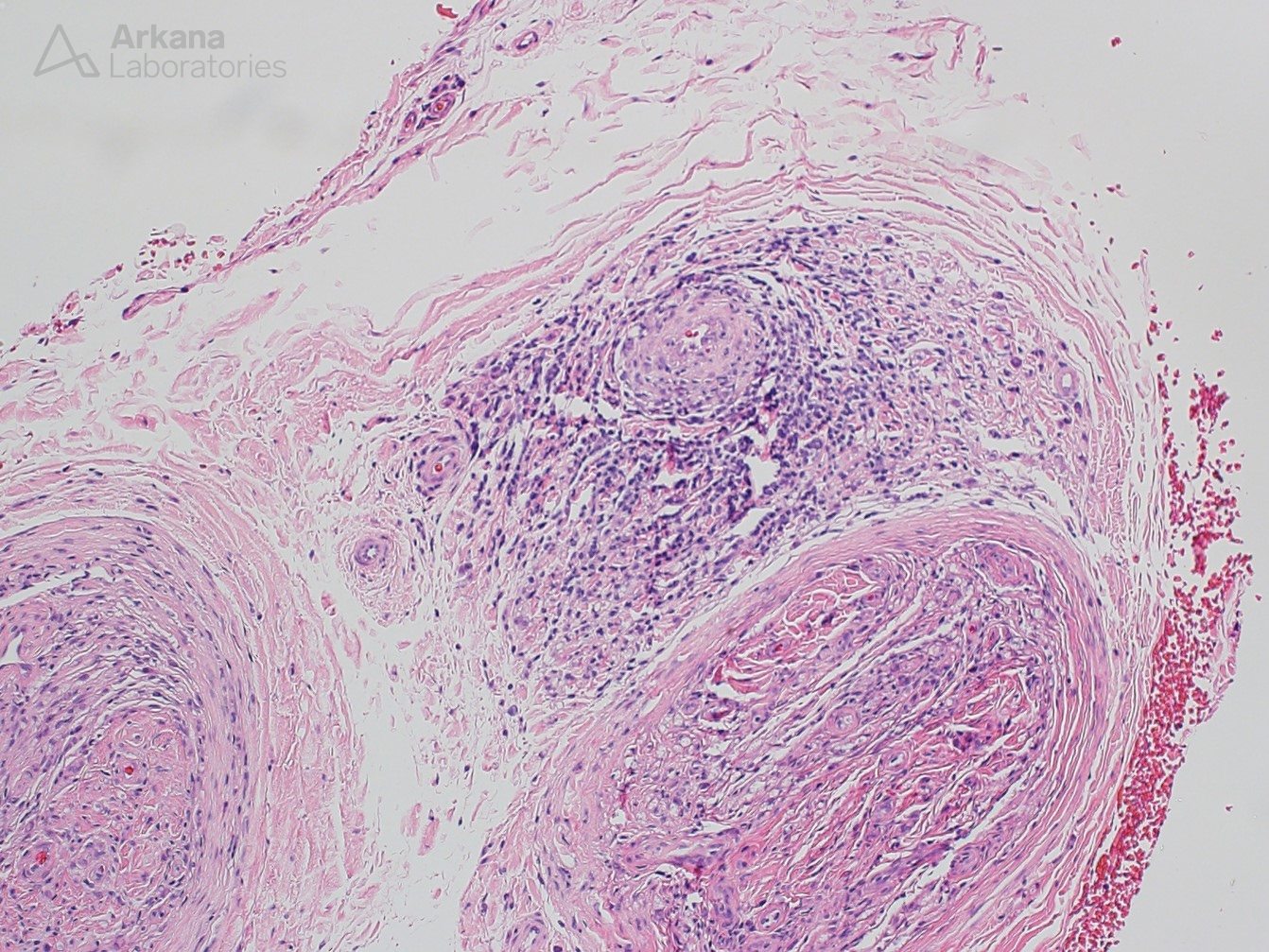 Unusual Inflammatory Neuropathy