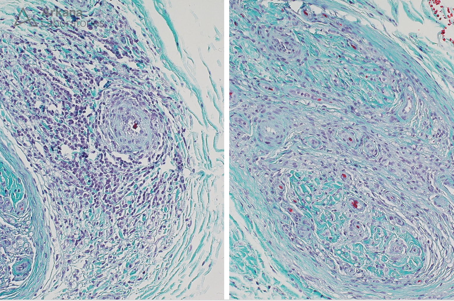 Unusual Inflammatory Neuropathy