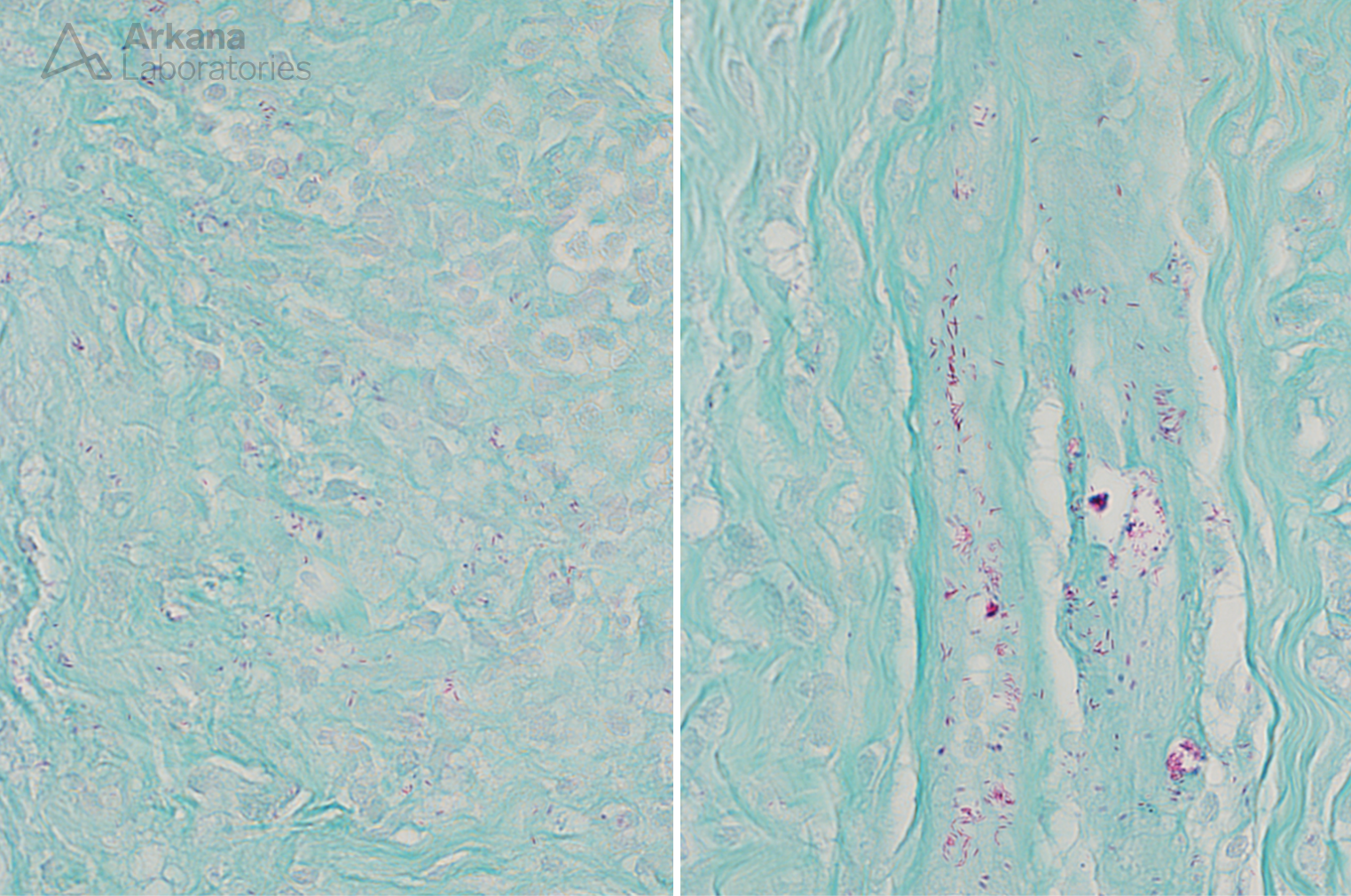 Unusual Inflammatory Neuropathy