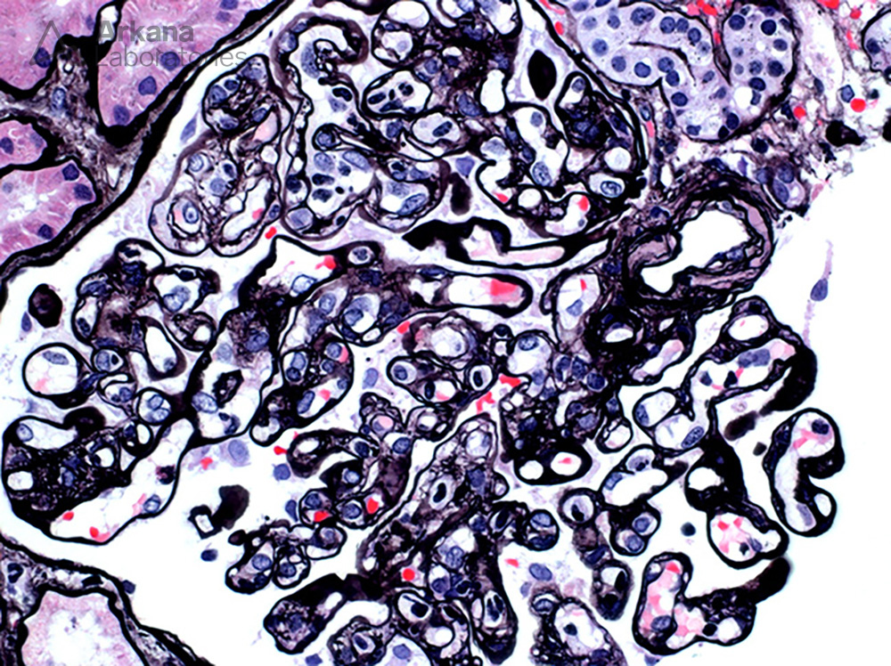 Chronic active antibody-mediated rejection