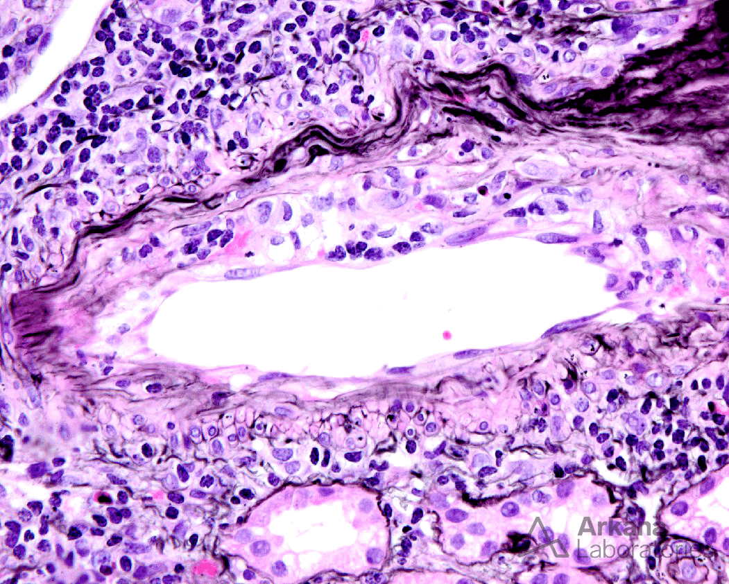 Diagnose this, endothelialitis characterized by mononuclear cell inflammation