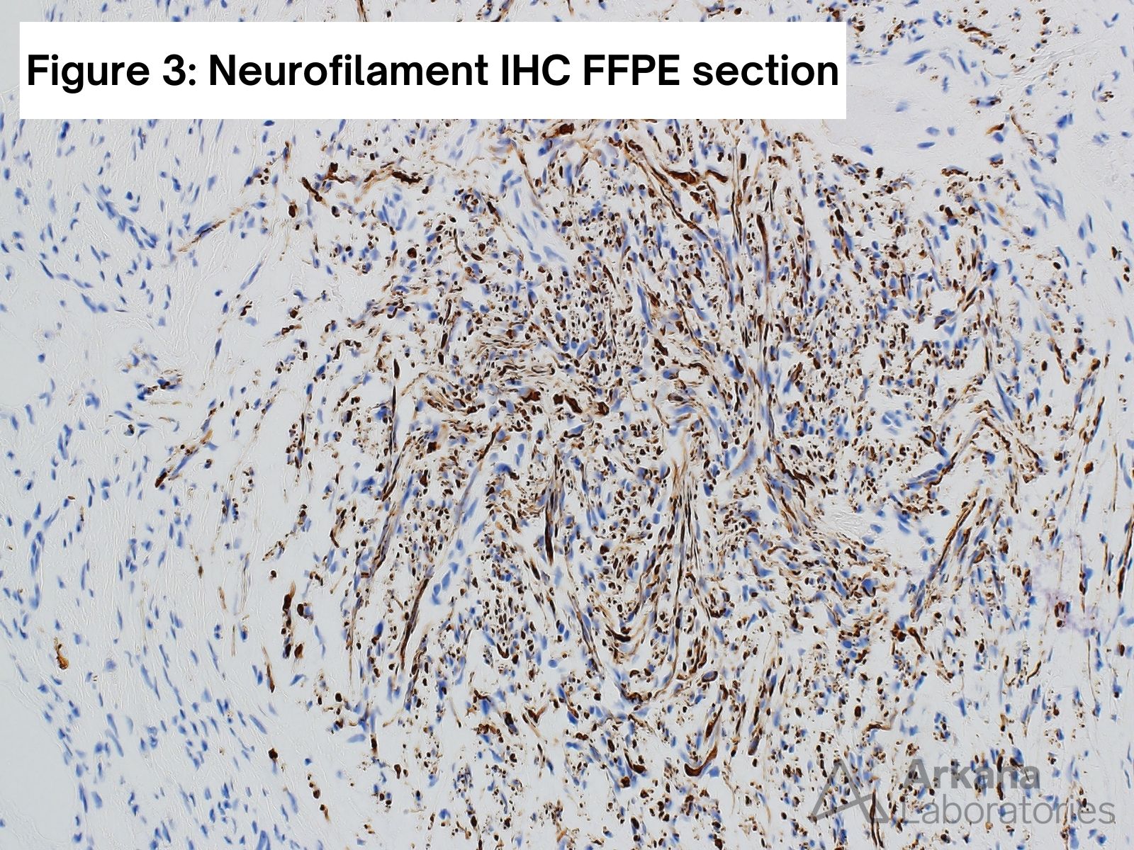 Traumatic neuroma