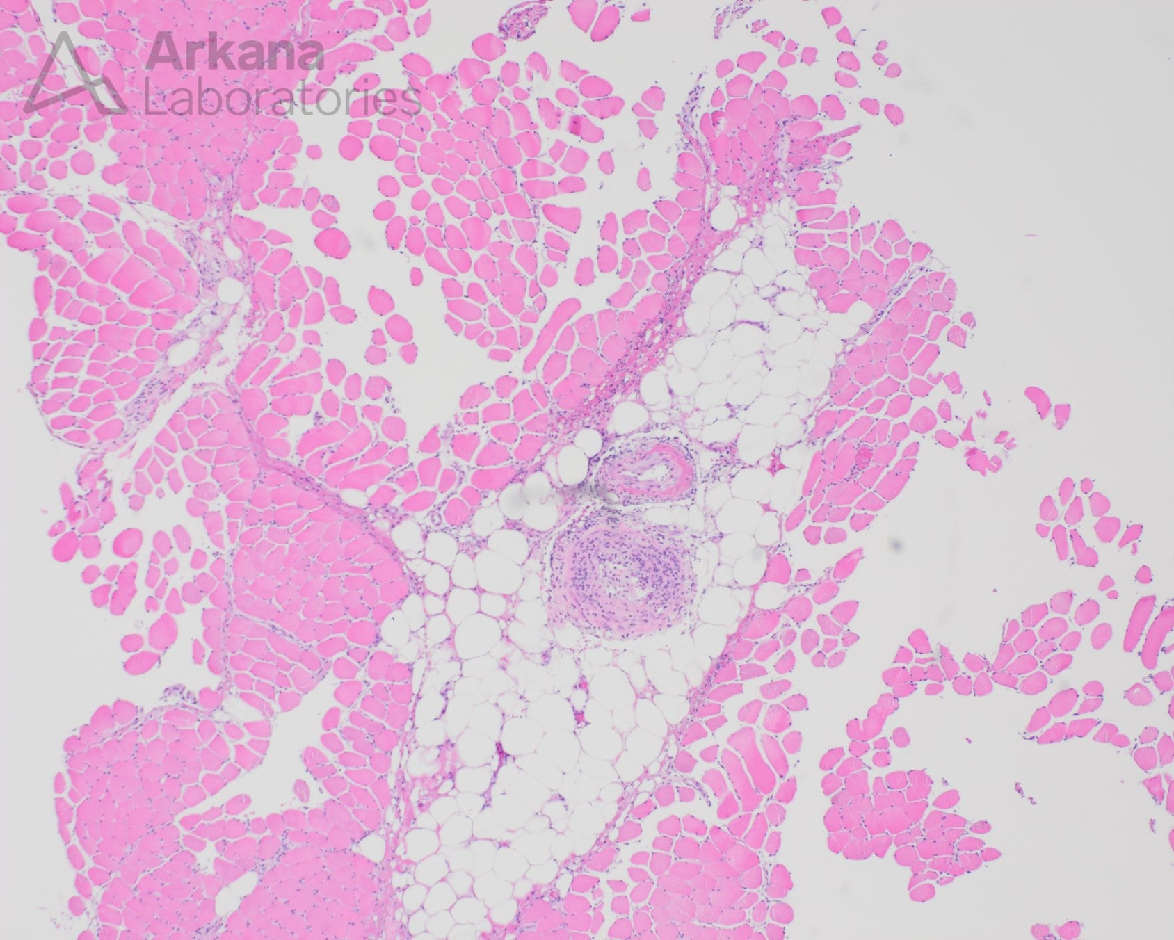 Active vasculitis with fibrinoid necrosis