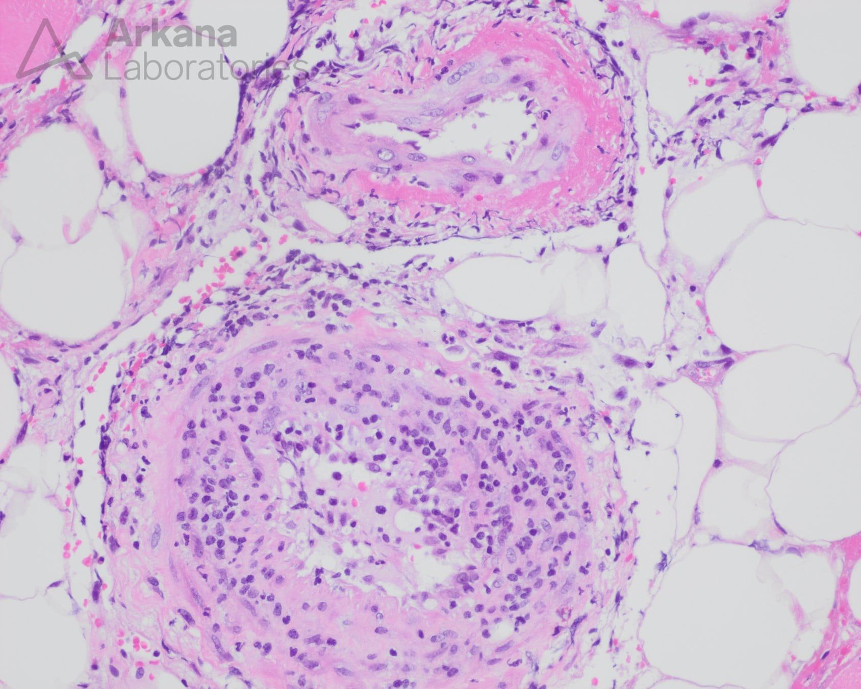Active vasculitis with fibrinoid necrosis