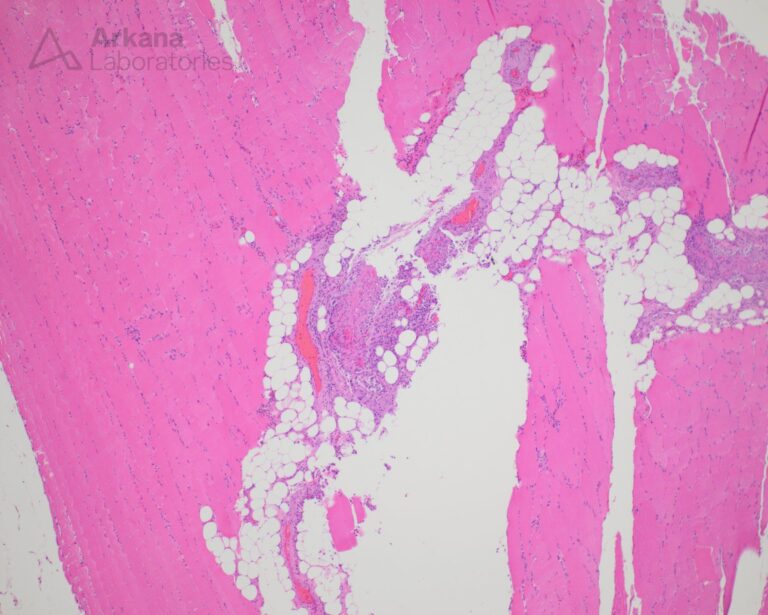 Eosinophilic granulomatosis with polyangiitis | Neuro Notes | Arkana ...