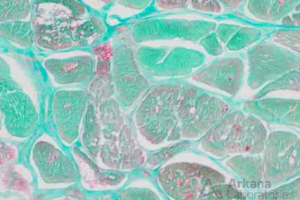 pompe disease - 3