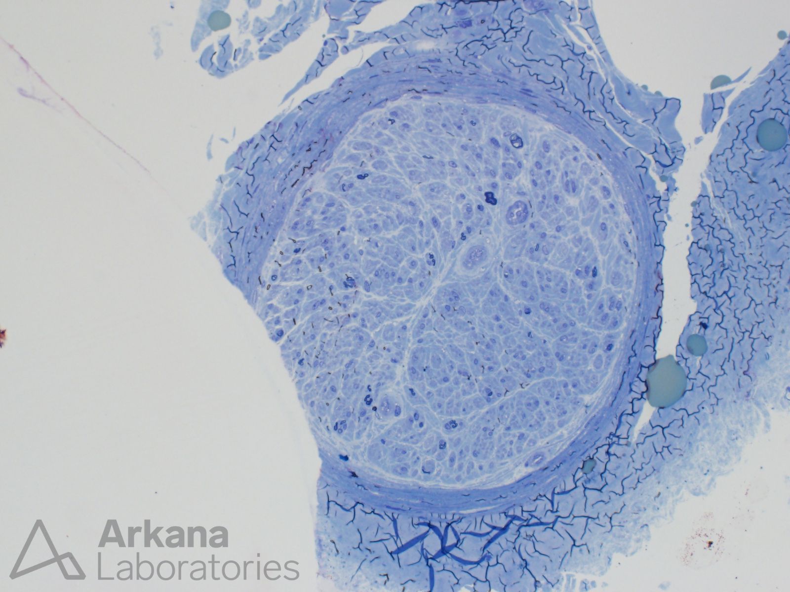 em thicks toluidine blue perineurial micromineralization