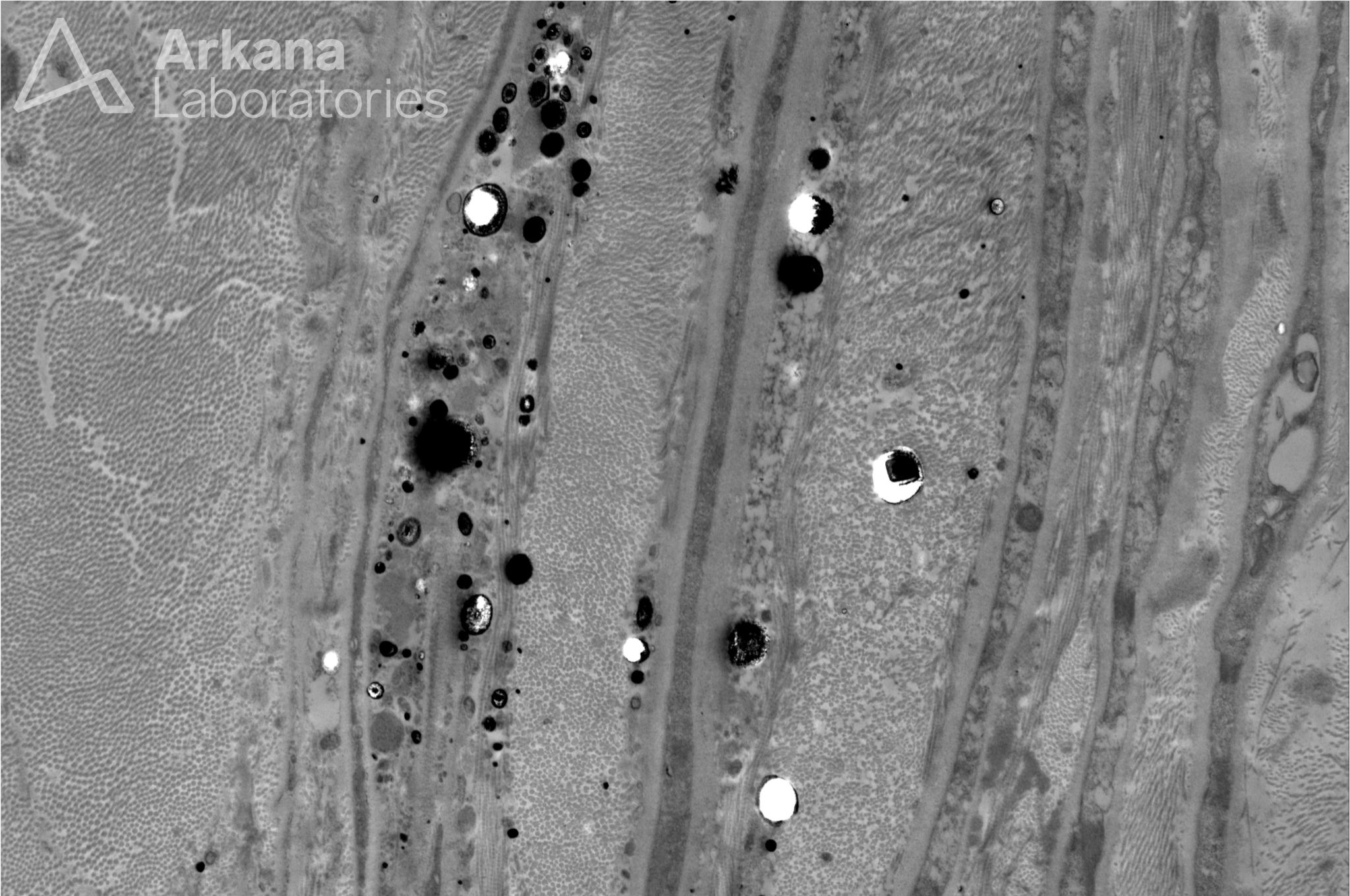 perineurial micromineralization