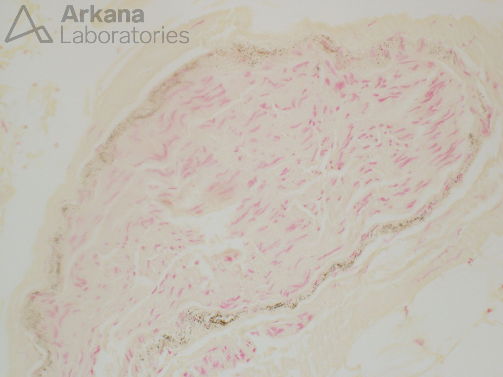 von kossa 1 perineurial micromineralization