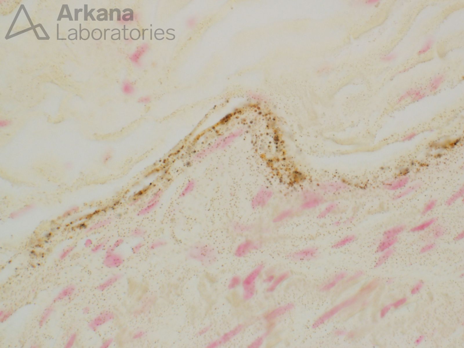 von kossa 2 perineurial micromineralization