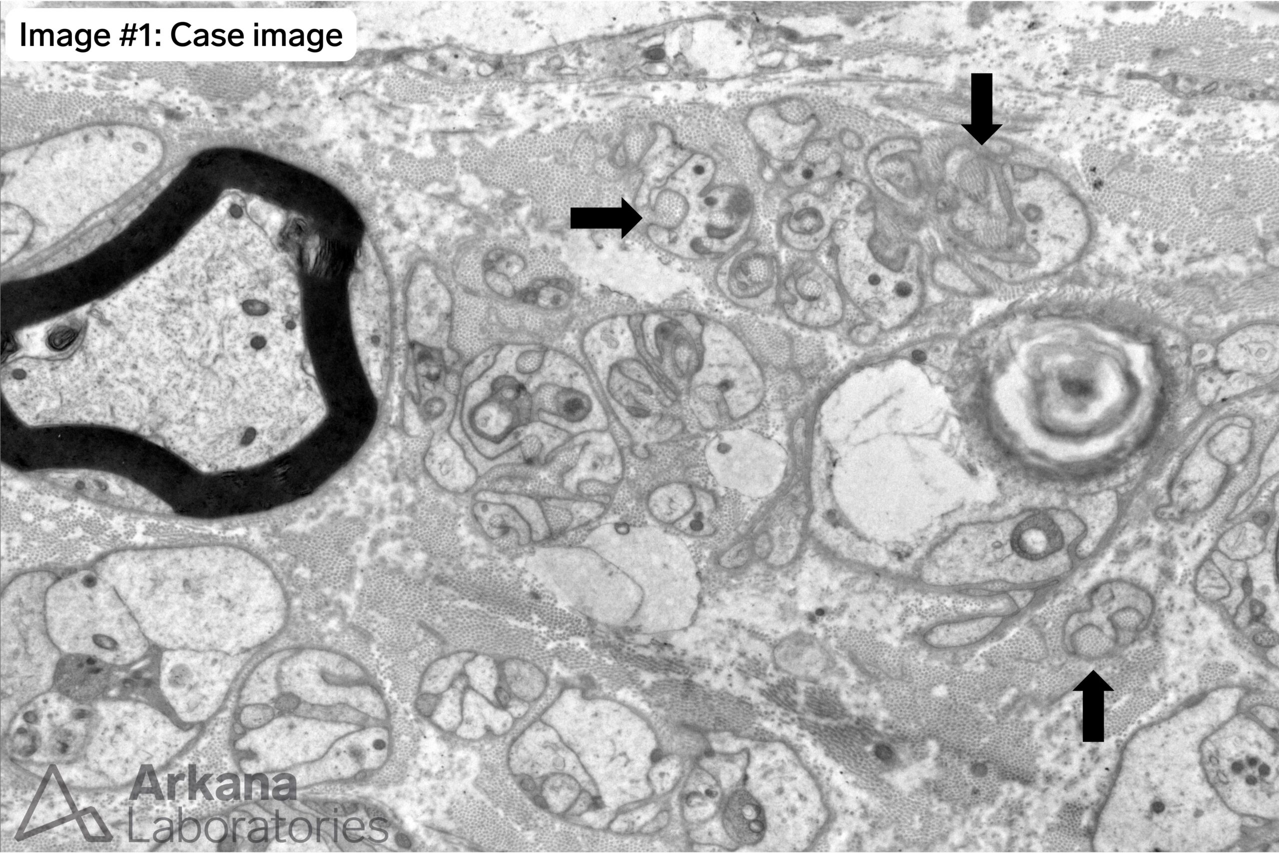 collagen pockets in nerve biopsy case image