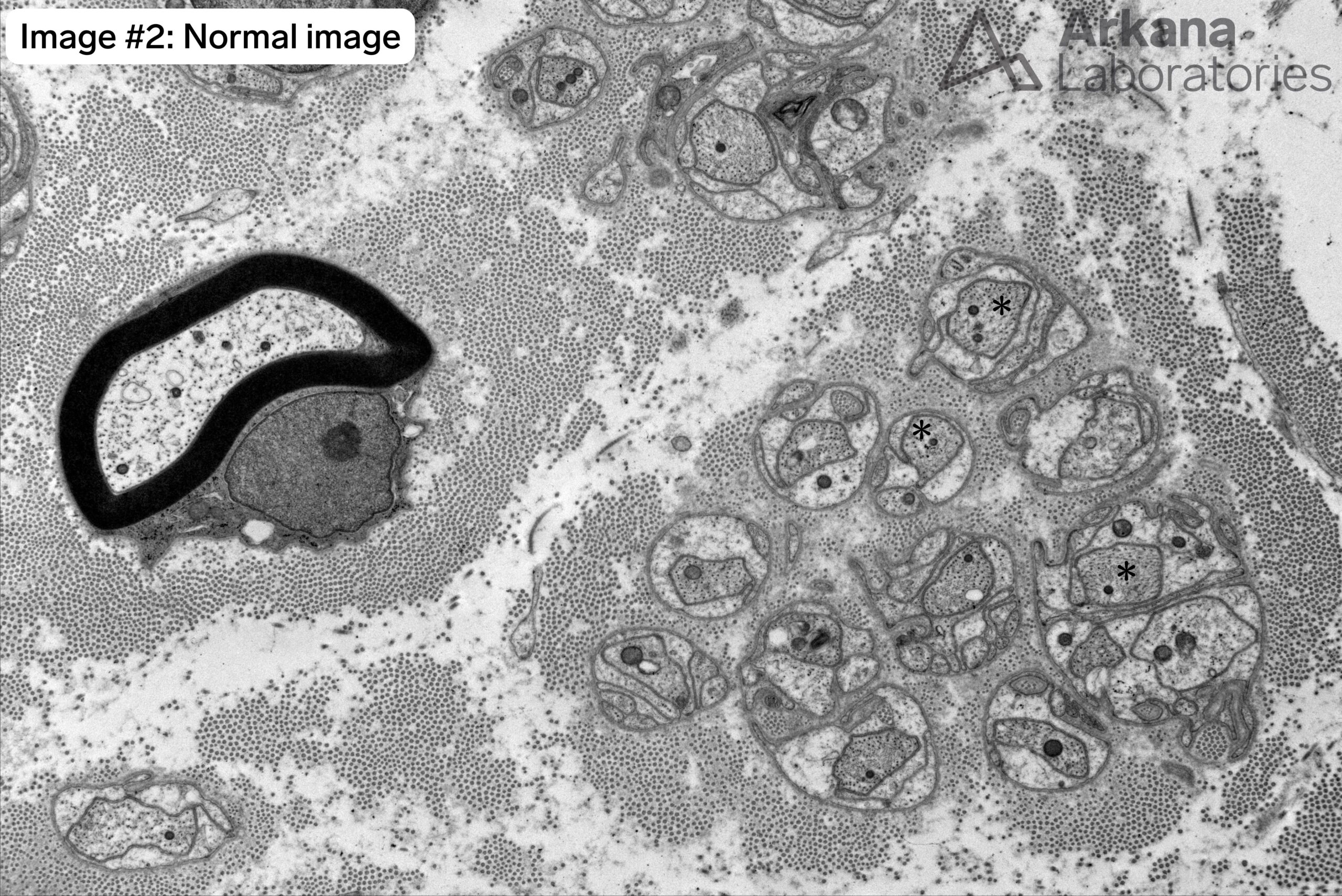 collagen pockets in nerve biopsy normal image